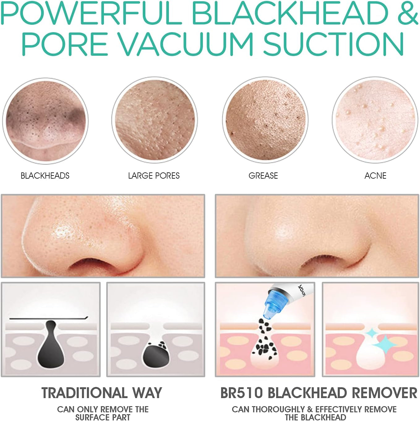 Blackhead Remover Pore Vacuum - Electric Face Vacuum Pore Cleaner Acne White Heads Removal with 6 Suction Heads (BR410)